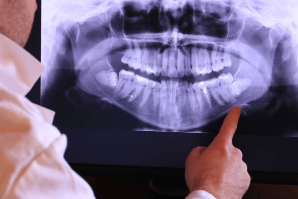 Best Emergency Tooth Extraction in Atherton, CA
